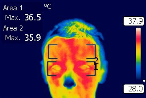红外热成像技术有助于诊断恶性肿瘤